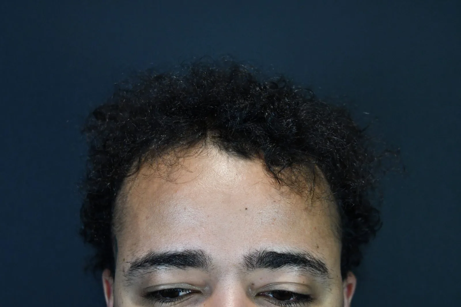 Close-up of male patient's forehead and hairline showing hair loss pattern